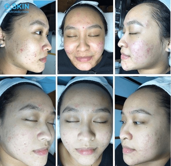 Các ca trị mụn trứng cá hiệu quả tại O2SKIN