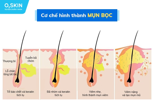 Cơ chế hình thành mụn bọc ở mặt