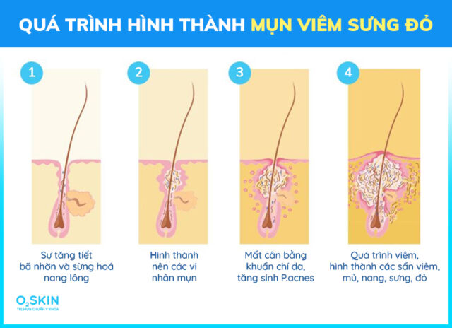 cơ chế hình thành mụn viêm sưng