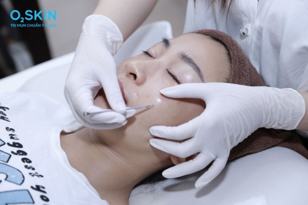 Điều trị mụn ẩn trên mặt