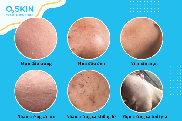 mụn ẩn để lâu ngày có sao không