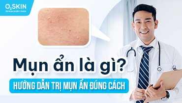 Mụn ẩn là gì? Dấu hiệu, cách điều trị và phòng ngừa hiệu quả