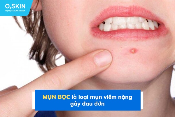 Mụn bọc có biểu hiện viêm, sưng đỏ ở mức độ nặng