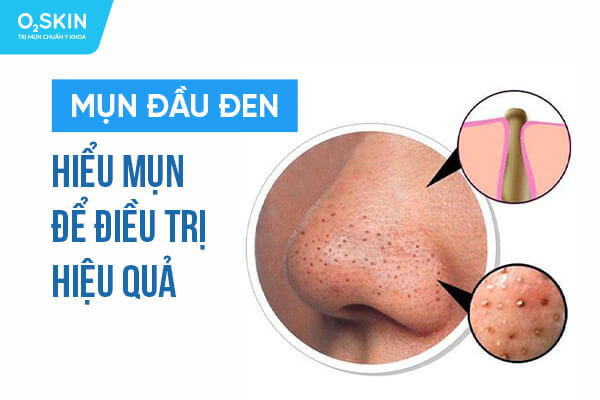 Tìm hiểu mụn đầu đen