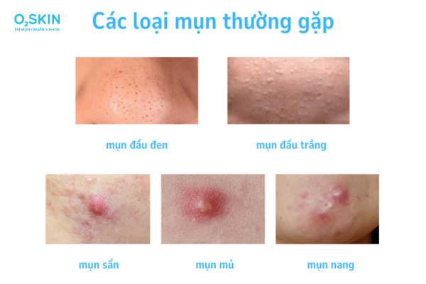 Các loại mụn trứng cá thường gặp