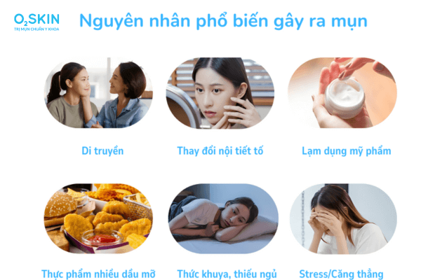 Nguyên nhân gây mụn trứng cá