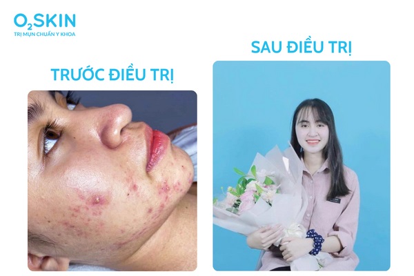 cách điều trị mụn viêm