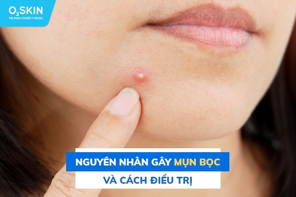 Nguyên nhân gây mụn bọc và cách điều trị