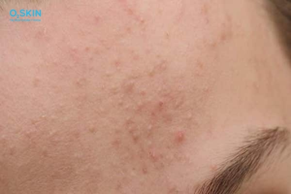 Nguyên nhân mụn ẩn