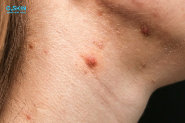 Nguyên nhân mụn bọc