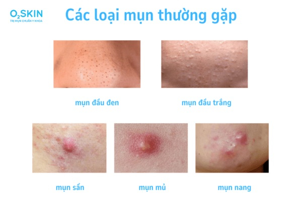 phân loại mụn trứng cá