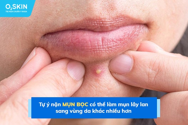 Tự ý nặn mụn bọc có thể làm mụn lây lan sang vùng da khác nhiều hơn