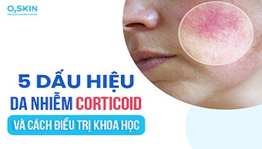 Da nhiễm corticoid: Dấu hiệu, nguyên nhân và cách phục hồi