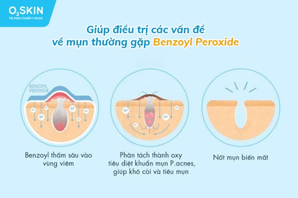 Benzoyl Peroxide giúp điều trị các vấn đề về mụn thường gặp