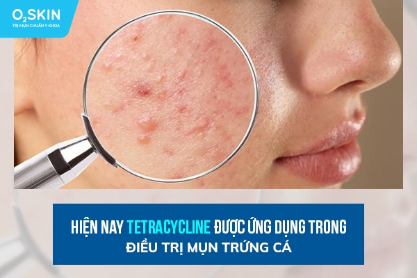 Tetracyclin giúp ngăn chặn sự phát triển của vi khuẩn gây mụn