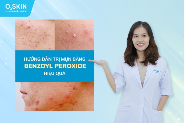 Benzoyl Peroxide - Hoạt chất vàng trong điều trị mụn trứng cá