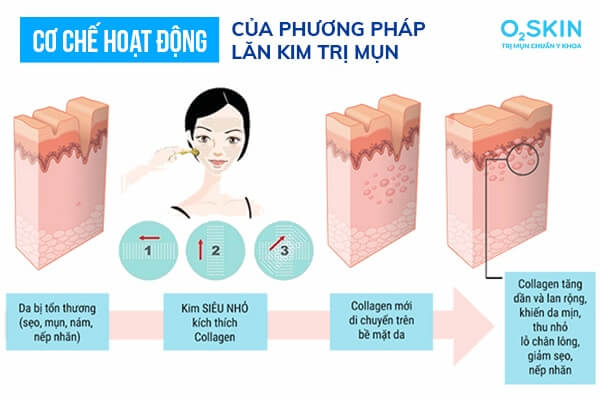 tác hại của lăn kim trị mụn