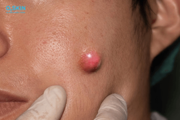 Mụn bọc bao lâu thì chín