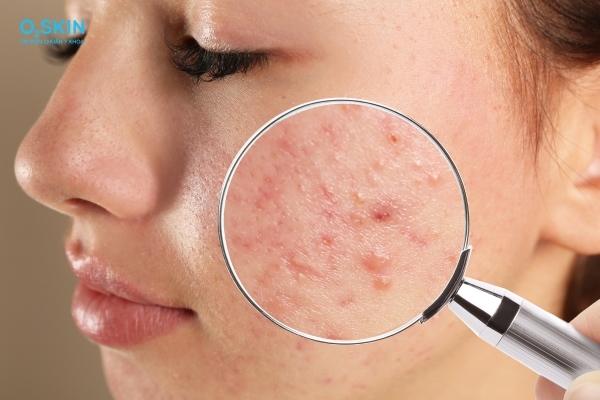 tác dụng phụ isotretinoin