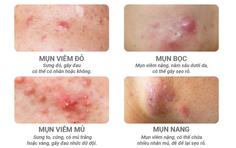 O2 SKIN là phòng khám trị mụn viêm thỏa mãn 2 điều kiện trên