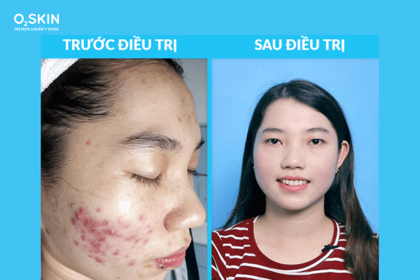 dầu mù u trị mụn được không