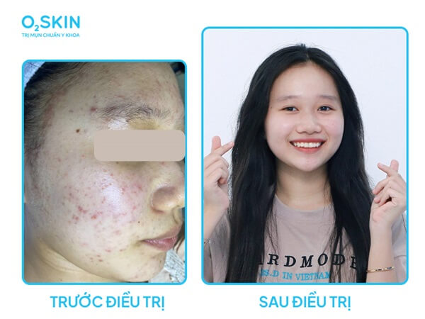 đeo khẩu trang nhiều có bị mụn không