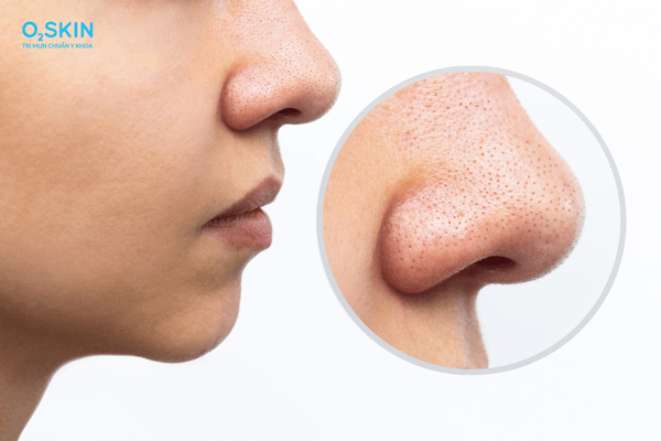 Mụn đầu đen có tự hết được không