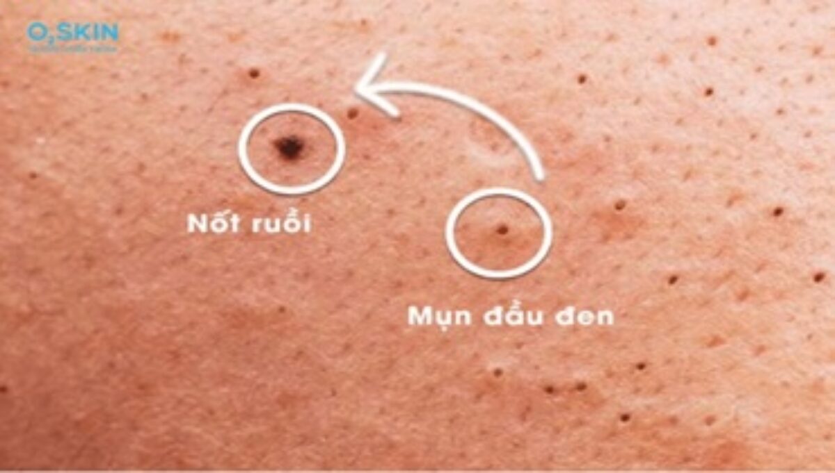MỤN VÀ NỐT RUỒI LÀ HAI TÌNH TRẠNG DA HOÀN TOÀN KHÁC NHAU VỀ NGUYÊN NHÂN