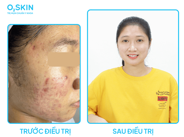 Khách hàng trị mụn tại O2 SKIN