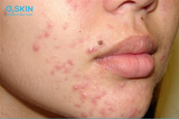 Bị mụn có nên tẩy tế bào chết không