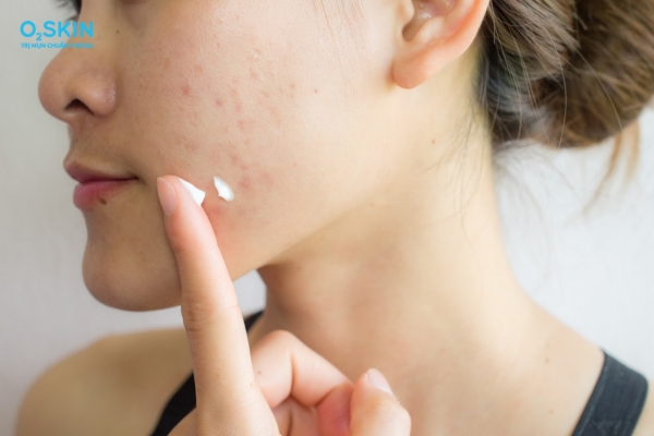 Cách trị mụn trên mặt