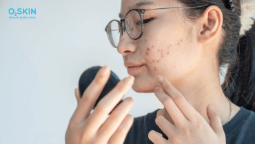 Khi dùng BHA bị đẩy mụn có nên nặn không? Giải đáp từ bác sĩ O2 SKIN