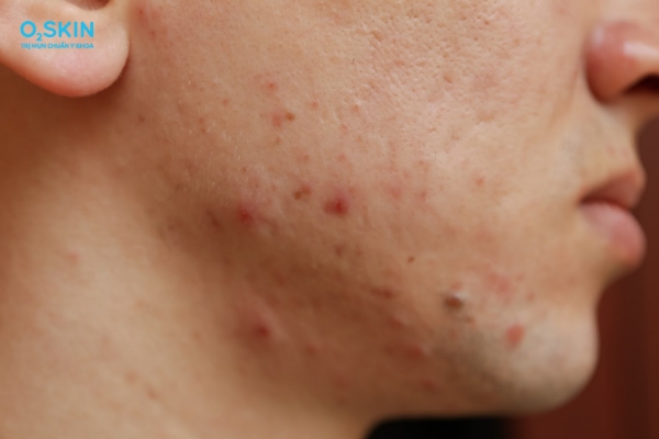 Nguyên nhân mụn mọc ở quai hàm