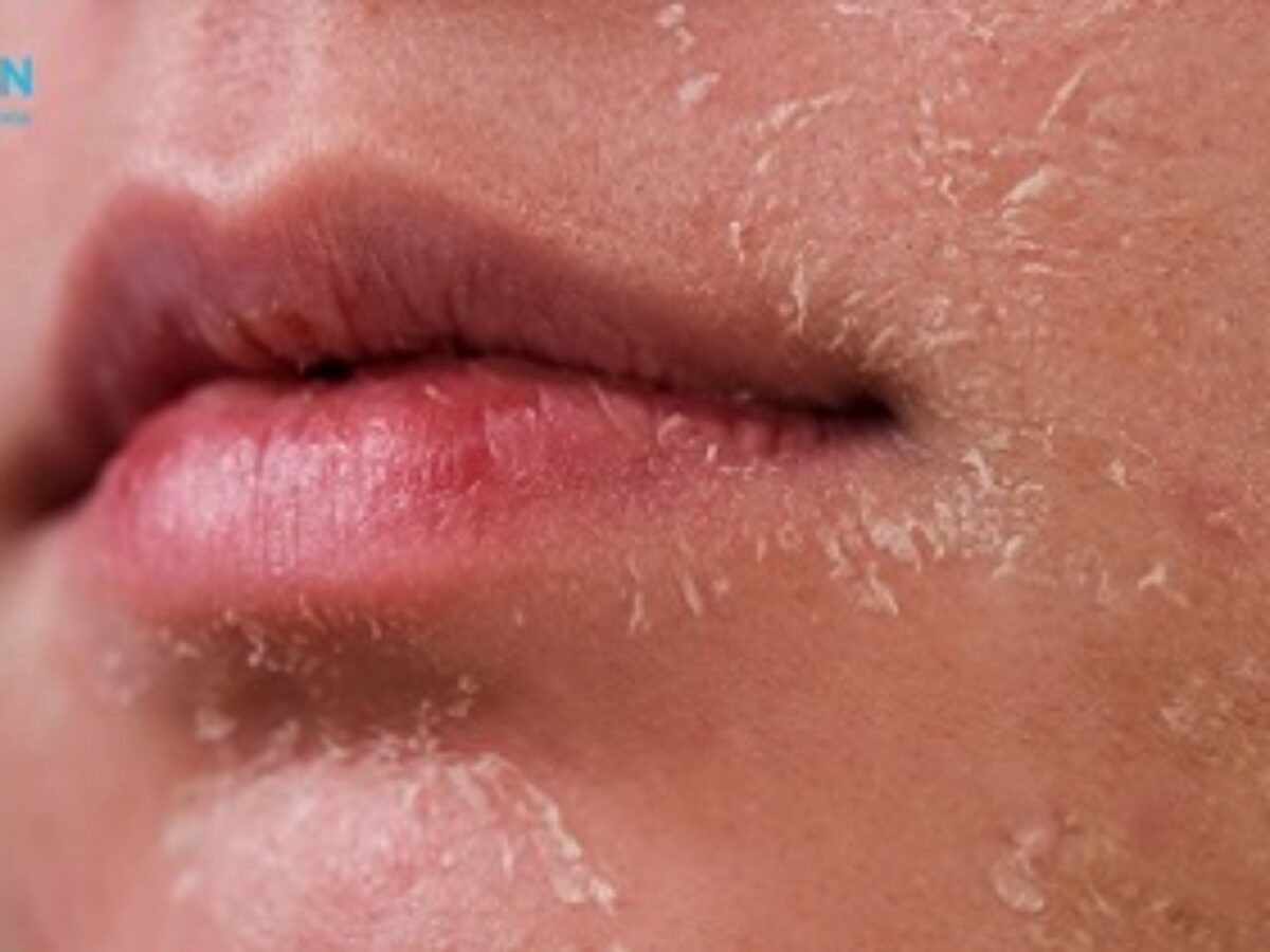 DA BỊ TĂNG SẮC TỐ SAU KHI PEEL CẦN XỬ LÝ ĐÚNG CÁCH