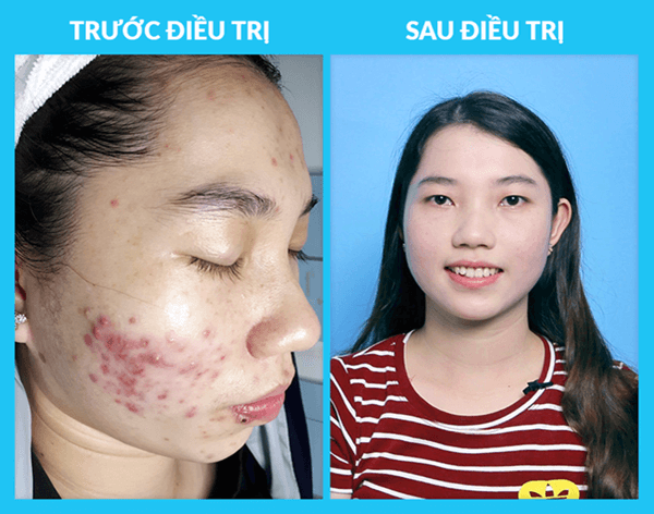 Khách hàng trị mụn tại O2 SKIN