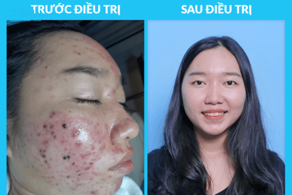 Hình ảnh trước và sau khi điều trị mụn tại O2 SKIN