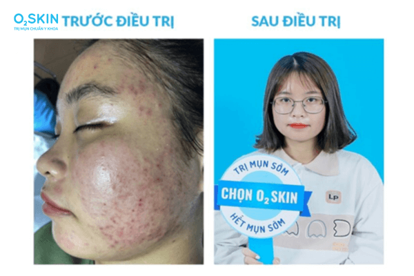 Da mụn trước và sau điều trị