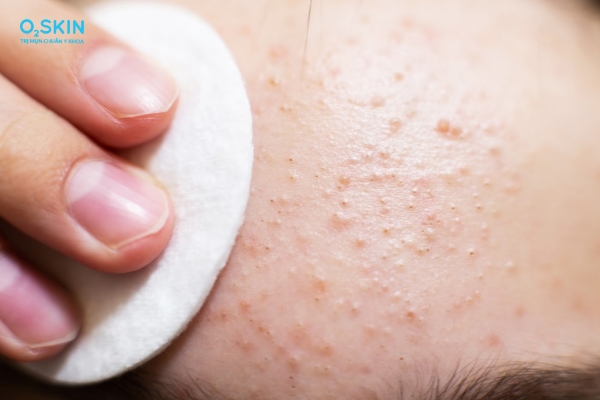 Mụn li ti trên trán