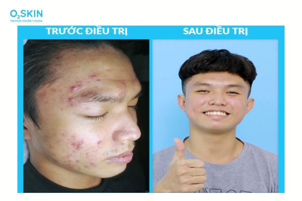 O2 SKIN - Địa chỉ lấy mụn chuẩn y khoa được gen Z tin chọn