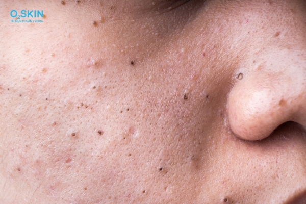 Mụn đầu đen 2 bên má do đâu