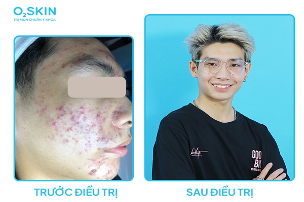 Trị mụn đầu đen ở má tại O2SKIN