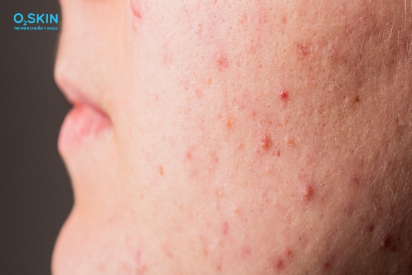 Dùng niacinamide bị lên mụn ẩn do đâu