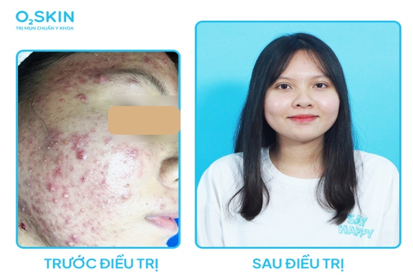 Điều trị mụn hiệu quả tại O2SKIN