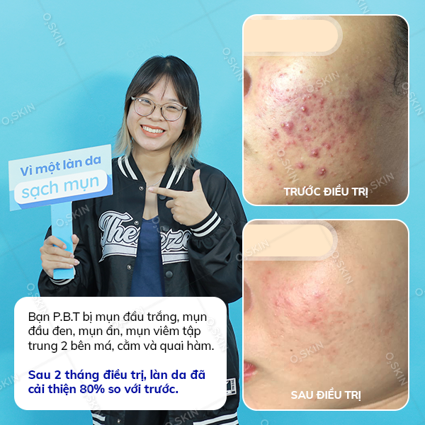 Kết quả trị mụn của khách hàng Phùng Bảo Tiên tại phòng khám da liễu O2 SKIN