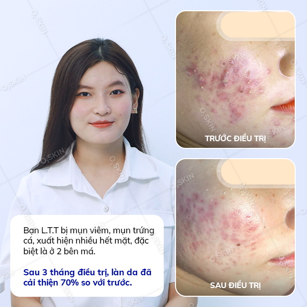 Kết quả trị mụn của khách hàng Lê Thị Tiên tại phòng khám da liễu O2 SKIN