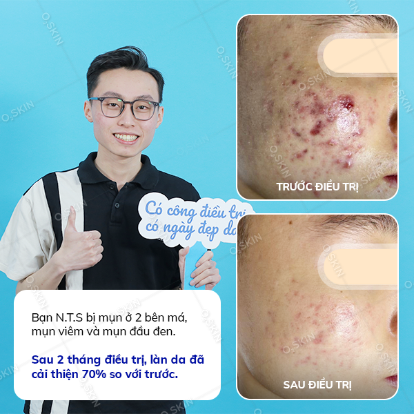 Kết quả trị mụn của khách hàng Ngô Thanh Sơn tại phòng khám da liễu O2 SKIN