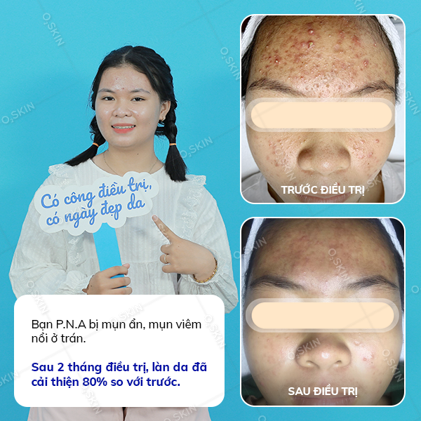 Kết quả trị mụn của khách hàng Phan Ngọc Anh tại phòng khám da liễu O2 SKIN
