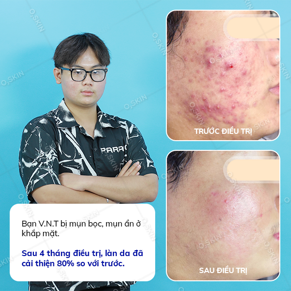 Kết quả trị mụn của khách hàng Võ Ngọc Trường tại phòng khám da liễu O2 SKIN
