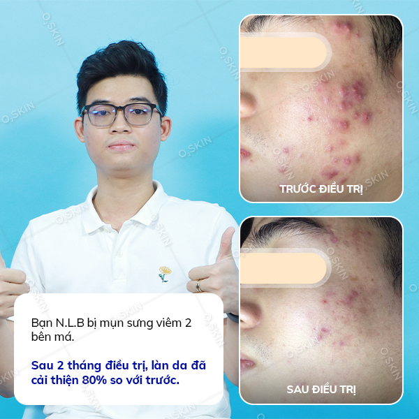 Kết quả trị mụn của khách hàng Nguyễn Long Bình tại phòng khám da liễu O2 SKIN