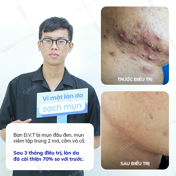 Kết quả trị mụn của khách hàng Đặng Văn Thương tại phòng khám da liễu O2 SKIN